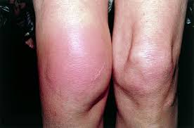 Hemartrosis. Hemorragia intraarticular en un caso de hemofilia A.