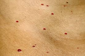 Nevus en rubí. Se deben a problemas vasculares y se pueden confundir con petequias. No son una manifestación hematológica.