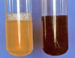 Orina colúrica (derecha) comparada con orina normal (izquierda). Se presenta en personas que tienen hemólisis intravascular (anemias hemolíticas).