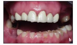 Pica. Destrucción de los dientes por masticar piedra (geofagia) en paciente con deficiencia de hierro.